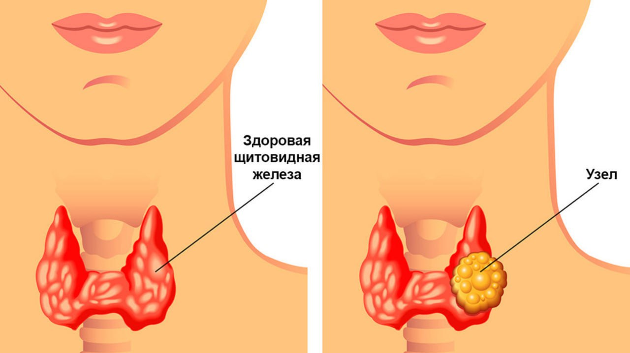 Как выглядит щитовидка у женщин в картинках