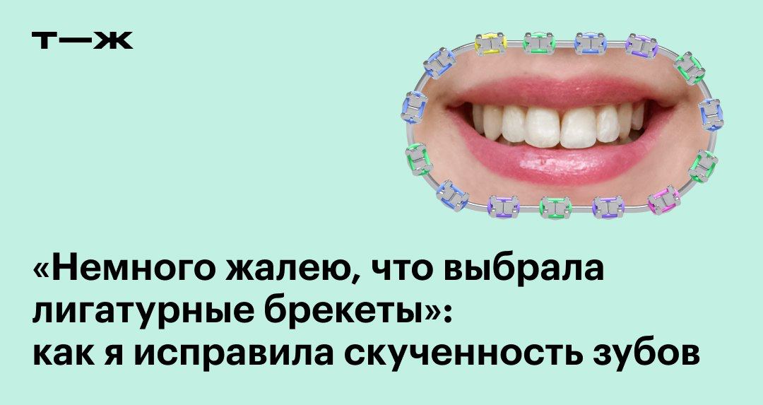 Немного жалеть. Ношу брекеты откололся зуб. Сколько носить брекеты минимальный срок.