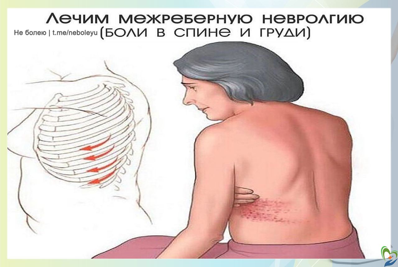 Межреберная невралгия лечение на левой стороне